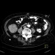 Carcinoma of ascending colon, colorectal carcinoma: CT - Computed tomography